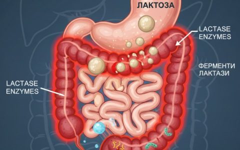 Непереносимість лактози
